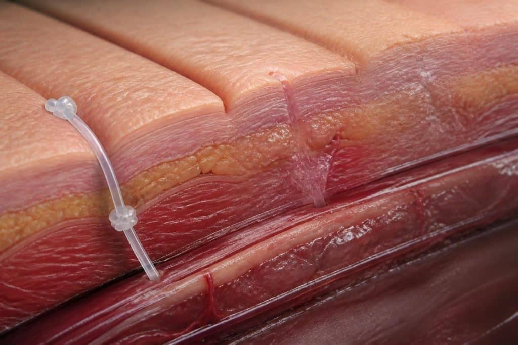 découvrez la durée de résorption des fils résorbables et suivez leur évolution progressive pour une meilleure compréhension de leur fonctionnement en chirurgie et soins médicaux.
