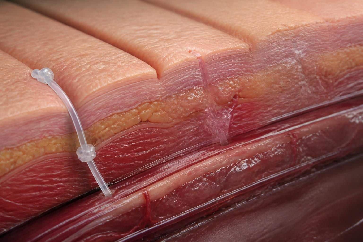 découvrez la durée de résorption des fils résorbables et suivez leur évolution progressive pour une meilleure compréhension de leur fonctionnement en chirurgie et soins médicaux.